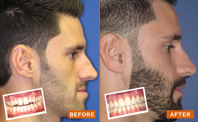 Before and after side-profile comparison of teeth alignment and orthodontic treatment results.