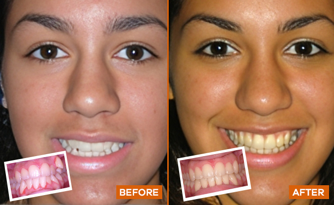 Before and after orthodontic treatment comparison showing improved smile and teeth alignment.