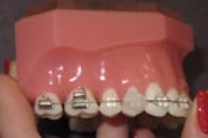 Close-up of upper teeth with metal orthodontic brackets and wires attached during treatment.