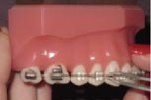 Orthodontist examining clear ceramic braces on patient's teeth during dental appointment.