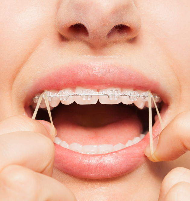 Person flossing teeth with braces during orthodontic care routine.