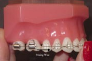 Dental braces model displaying metal brackets and wires on artificial teeth in pink demonstration model.