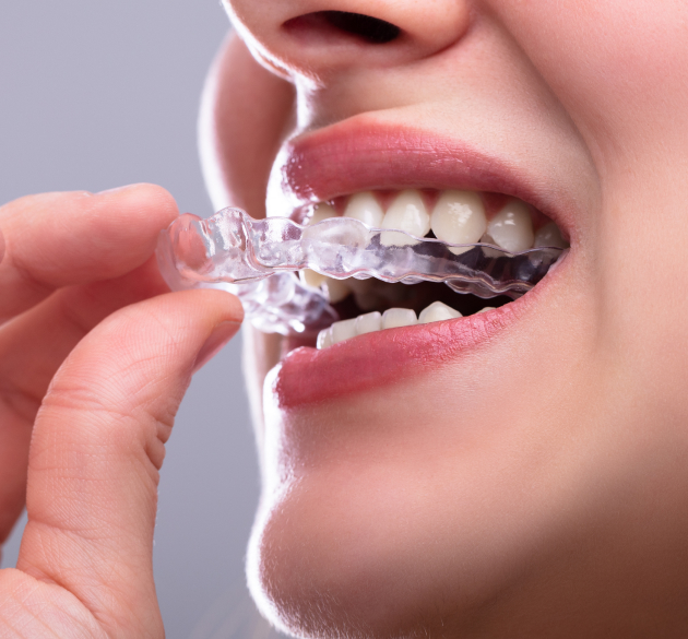 Person inserting clear orthodontic aligner into mouth, demonstrating invisible braces treatment.