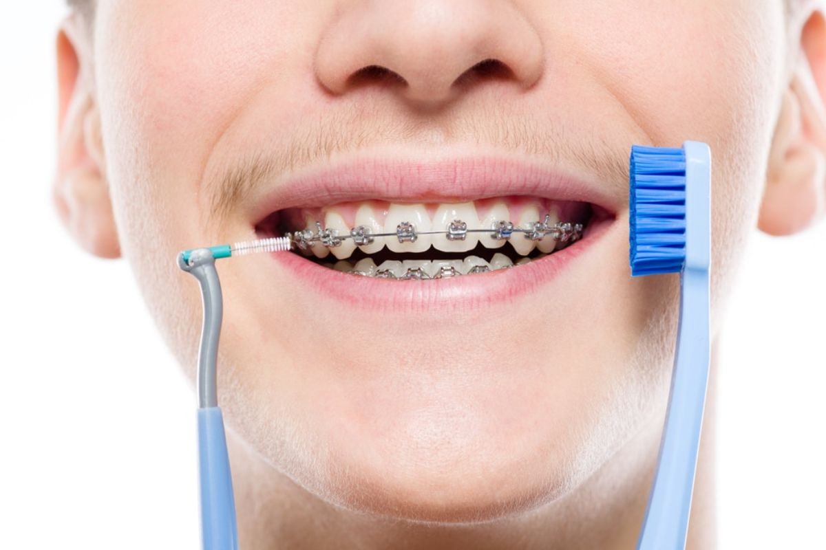 Person with metal braces holding blue toothbrush near mouth, demonstrating orthodontic dental care.