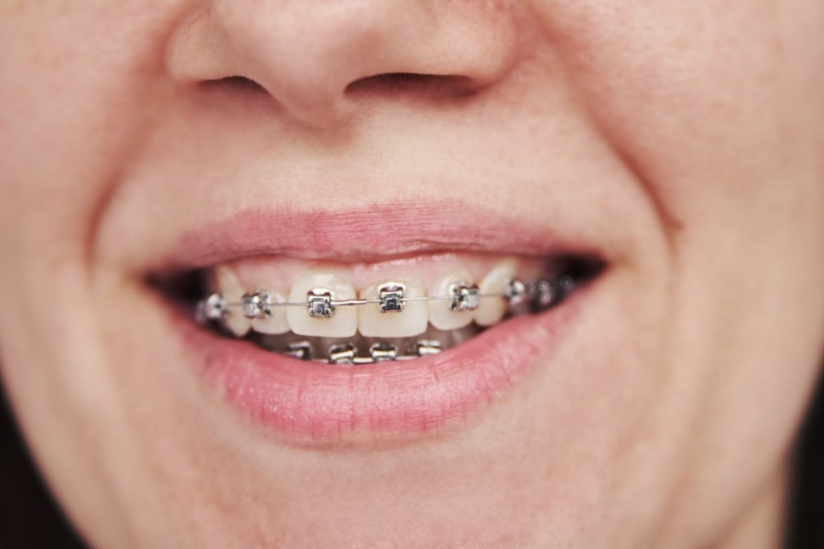 Close-up of smiling mouth displaying metal braces on upper teeth.