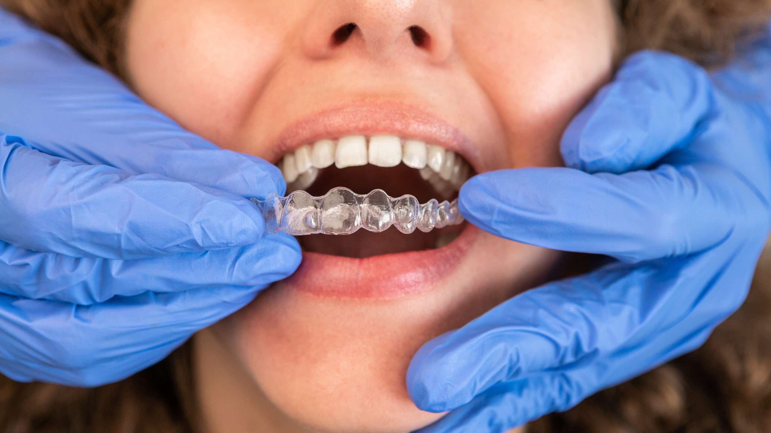 Orthodontist examining patient's clear aligner tray during dental appointment with gloved hands.